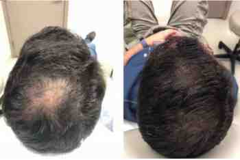 Pepfactor Hair and Scalp Before and After