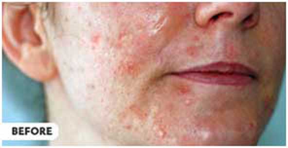 Lap acne 1